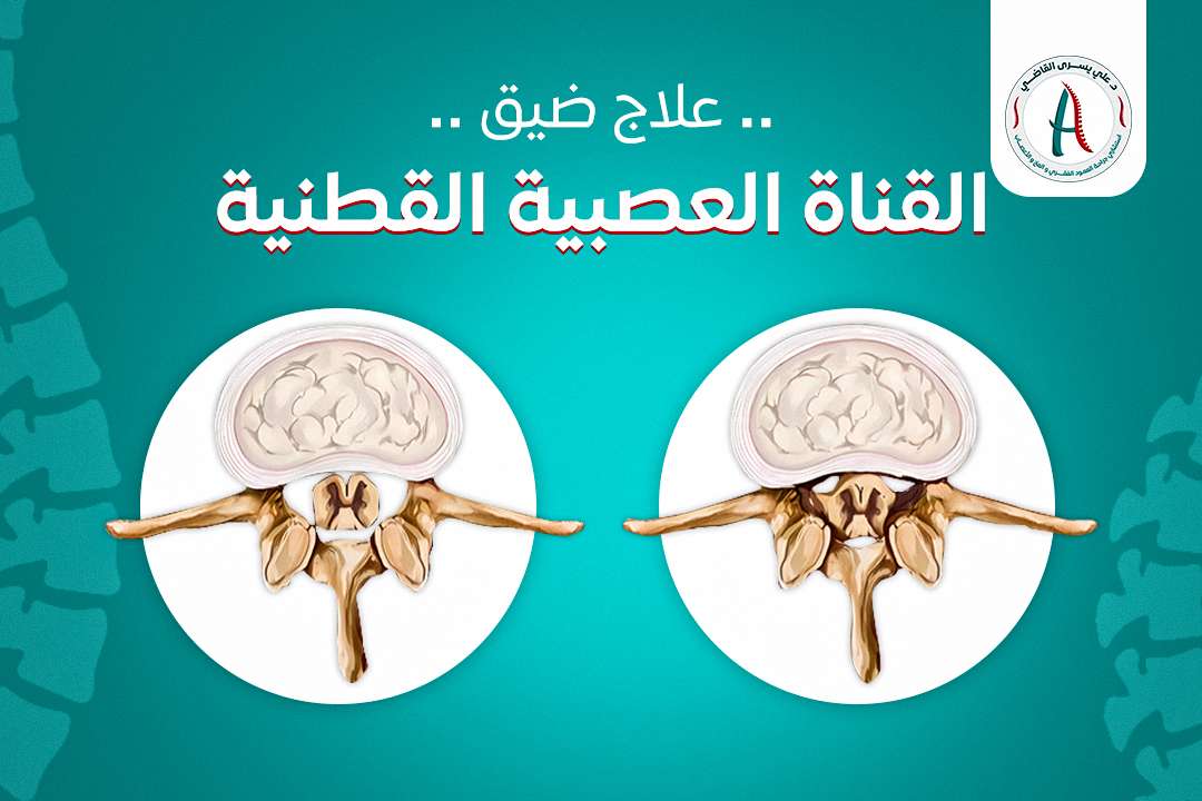 علاج ضيق القناة العصبية القطنية .