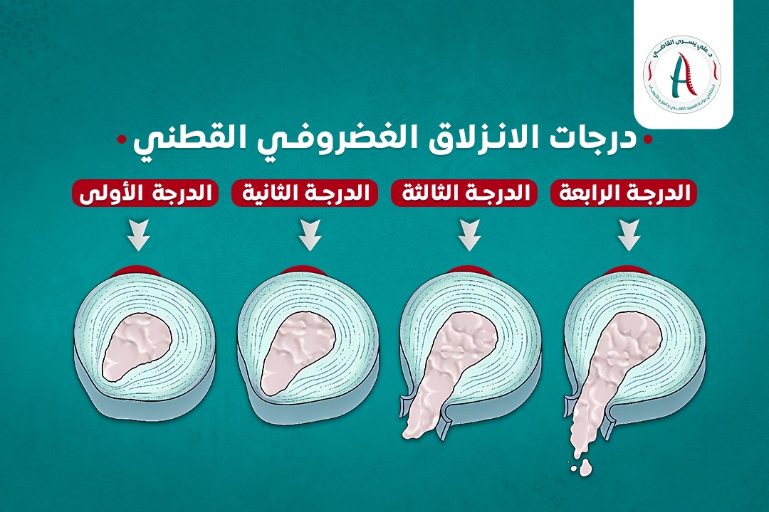 درجات الانزلاق الغضروفي القطني وطرق علاجها