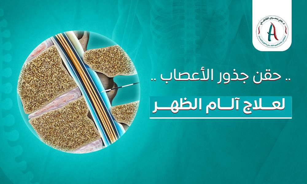 حقن جذور الأعصاب لعلاج آلام الظهر