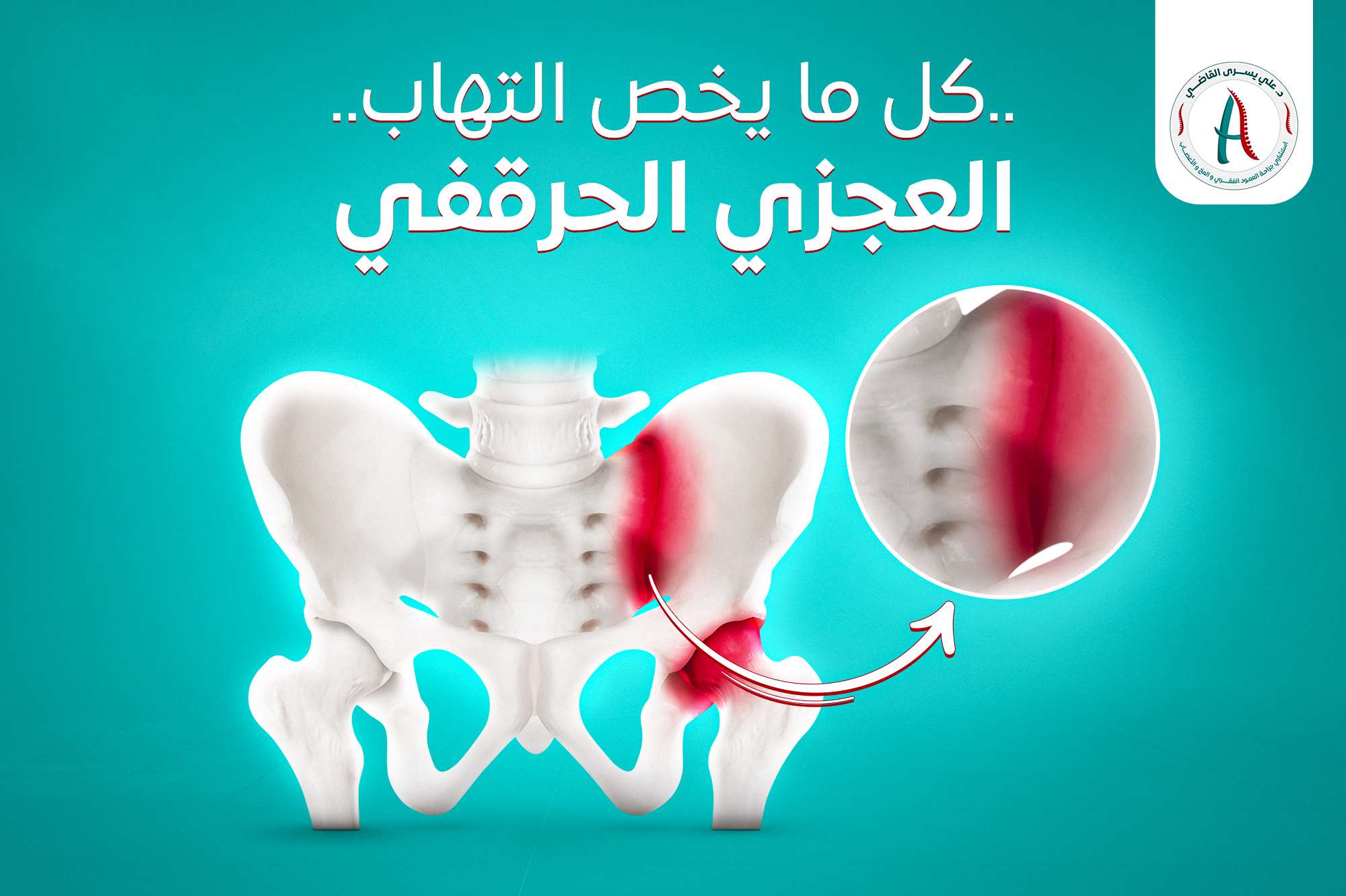أعراض وأسباب التهاب المفصل العجزي الحرقفي