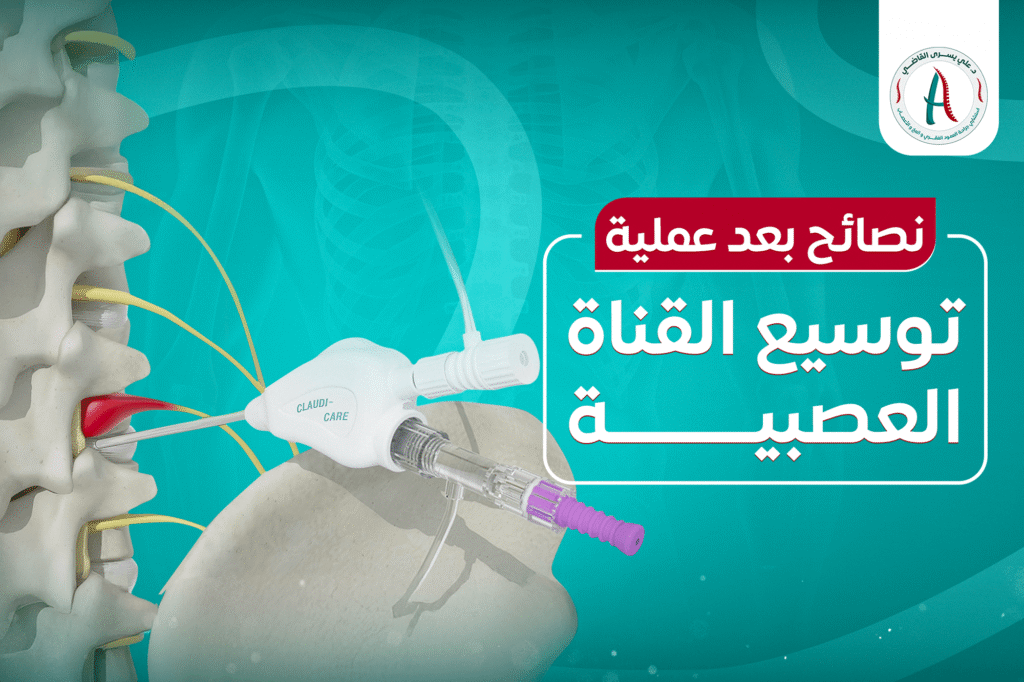 نصائح بعد عملية توسيع القناة العصبية
